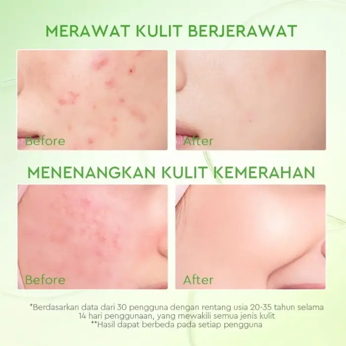 Glad2Glow Kiwi 3D Acid Acne Moisturizer - Gambar 3
