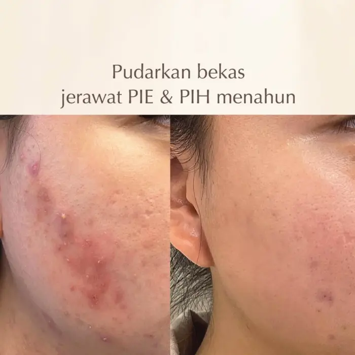 Polynia Orange Brightening Face Mask | Memudarkan Bekas Jerawat - Gambar 4
