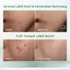 Glad2Glow Acne Drying Lotion Set - Mengeringkan Jerawat - Gambar 3