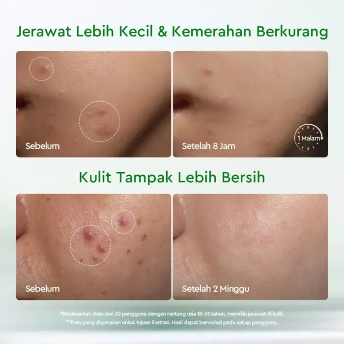 Glad2Glow Acne Drying Lotion Set - Mengeringkan Jerawat - Gambar 3