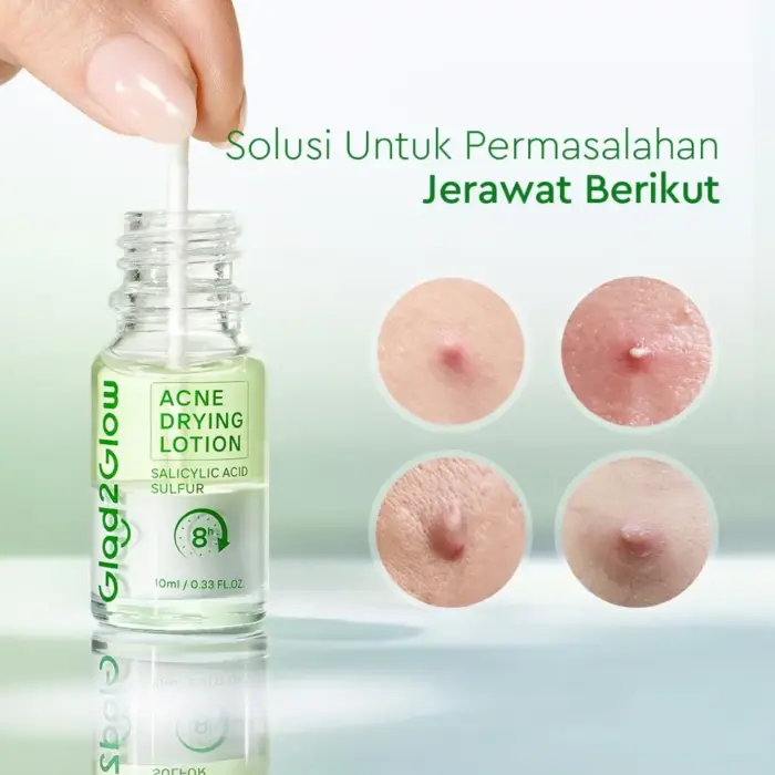 Glad2Glow Acne Drying Lotion Set - Mengeringkan Jerawat - Gambar 2
